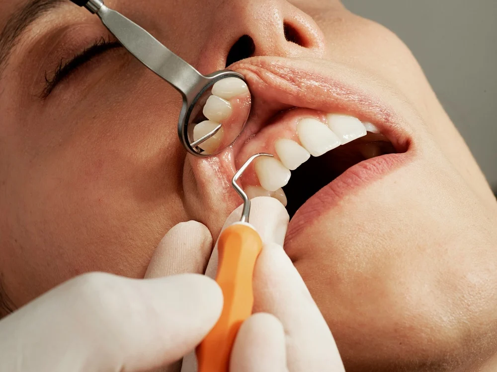 Dentist checking tooth caries or cavities